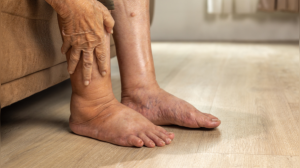7 Warning Signs of Kidney Damage You Shouldn't Ignore