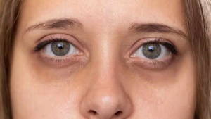 Tiêu đề: Under-Eye Circles: Could They Signal Kidney, Liver, or Other Health Problems?