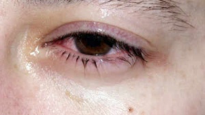 Morning Eye Crust: Causes, Treatment, and When to See a Doctor