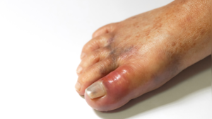 High Uric Acid and Your Skin: 5 Warning Signs to Watch For