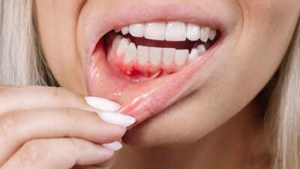 Gum Bleeding: 8 Serious Health Conditions It Could Signal