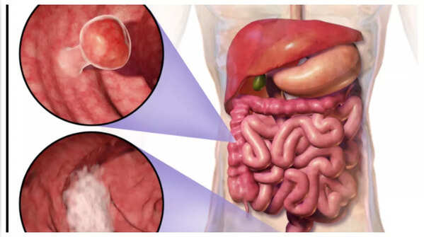 Blood in stool: A crucial warning sign.