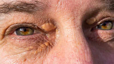 High cholesterol signs that appear on your skin before a heat test