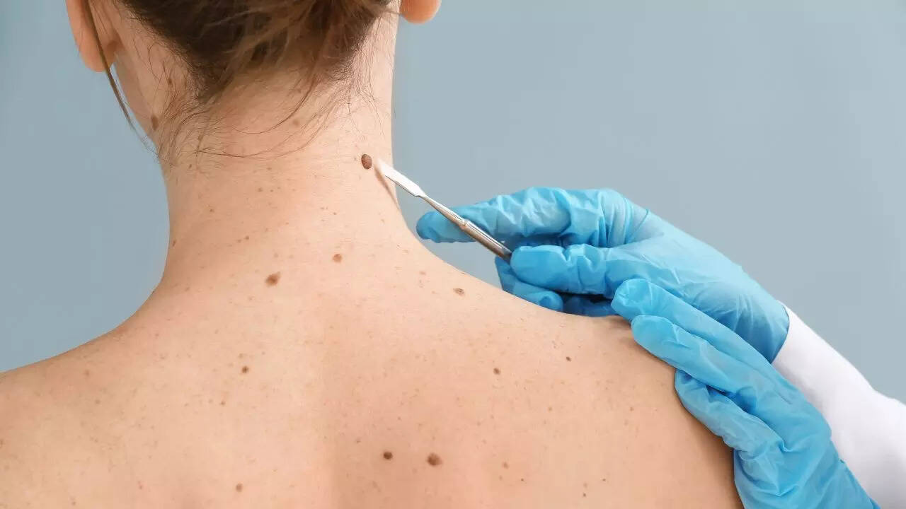 Skin cancer symptoms