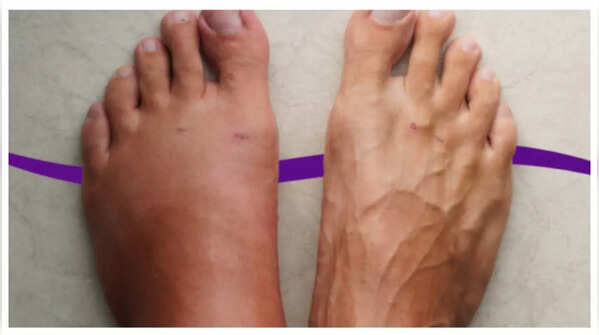 Swelling in lower body
