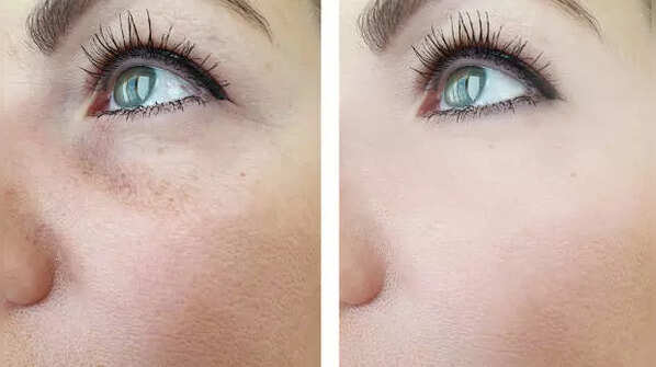 Bye bye dark spots