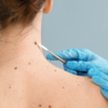 Abnormal moles or skin changes