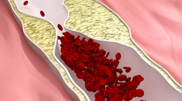 People with advanced peripheral artery disease